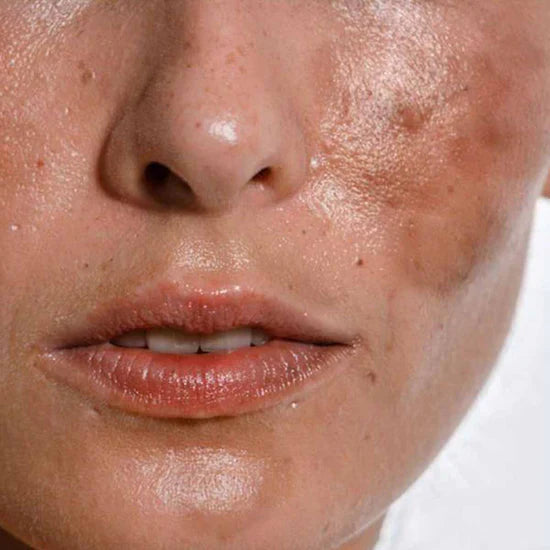 Dark Spots & Marks